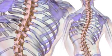Neue S2k-Leitlinie zur idiopathischen Skoliose im Jugendalter